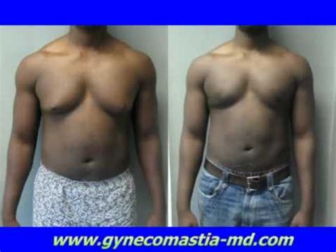 Gynecomastia Surgery Severe Male Breast Reduction Surgery