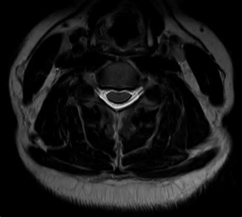 Comprehensive Cervical Spine Imaging At 3 0t Philips Mr Body Map