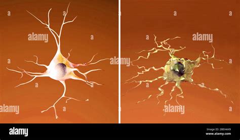 Neurona Normal Y Moribunda Enfermedad De Alzheimer Fotografía De Stock Alamy