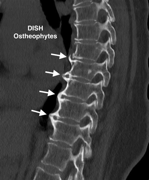 A Closer Look at DISH: Idiopathic Skeletal Hyperostosis Explained