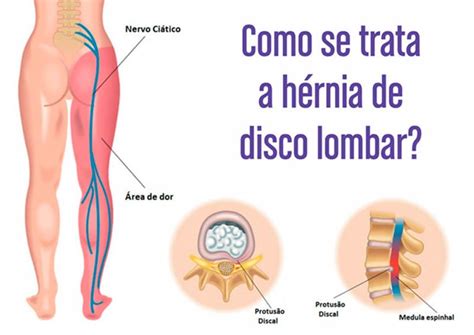 Dor No Quadril Dr Honorato