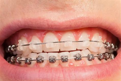 Ceramic Braces What Do They Cost And Should You Get Them Dentaly Org