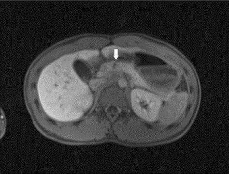 Magnetic Resonance Cholangiopancreatography Showing Transection At The Download Scientific