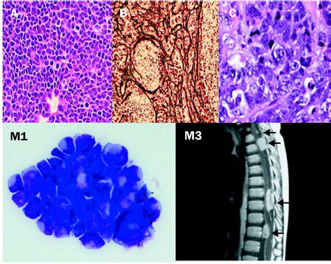 Medulloblastoma Signalling A Change In Treatment The Lancet Oncology