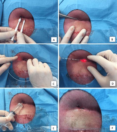 Pilonidal Abscess