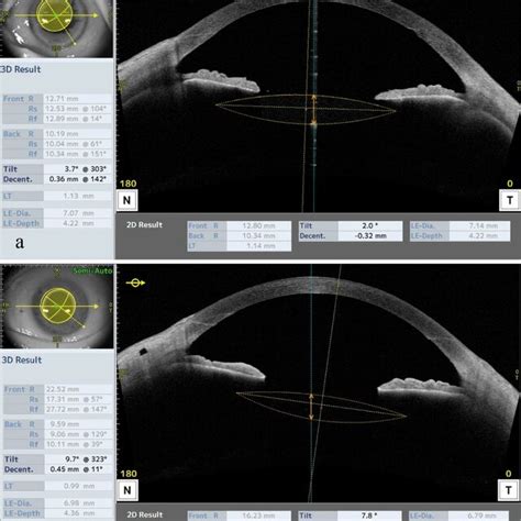 Anterior Segment Optical Coherence Tomography Images Of The Yamane