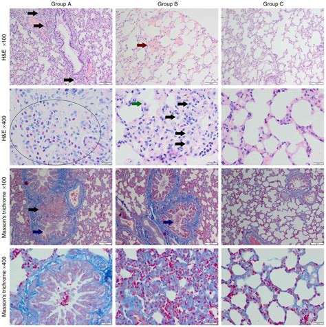 Smokers Lung Histology