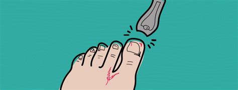 Taking A Look At Severe Psoriasis Symptoms and Ingrown Nails