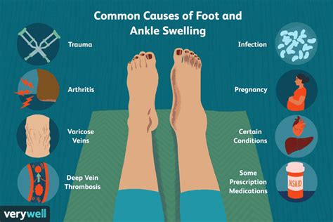 Why Is my Foot and Ankle Swollen? Cause and Treatments