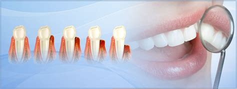 ¿qué Es La Enfermedad Periodontal Clinica Dentral Dr Calvarro