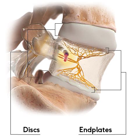 Vertebrogenic Pain - The Intracept Procedure by Relievant