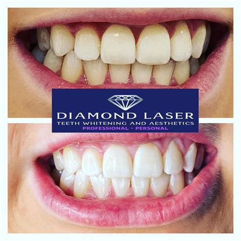 Gallery Diamond Laser Teeth Whitening And Aesthetics