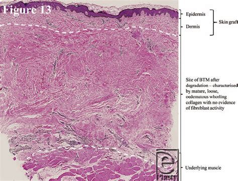 Explanatory Diagram Demonstrating The Strata Of The Punch Biopsy