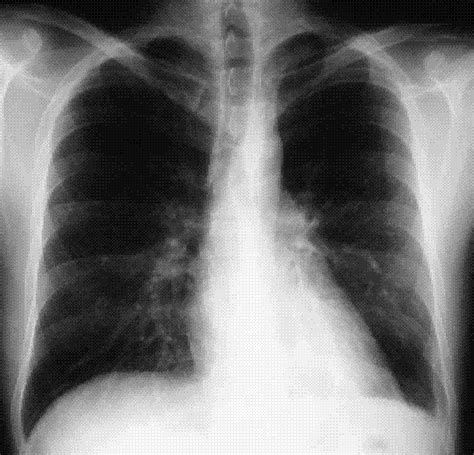 Ciencia Guía Práctica Para La Interpretación De Una Radiografía De Tórax Normal