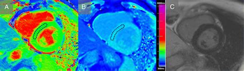 Native And Post Contrast T1 Mapping And Lge Imaging In Hypertension