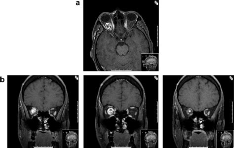 Fractionated Stereotactic Conformal Radiotherapy For Optic Nerve Sheath