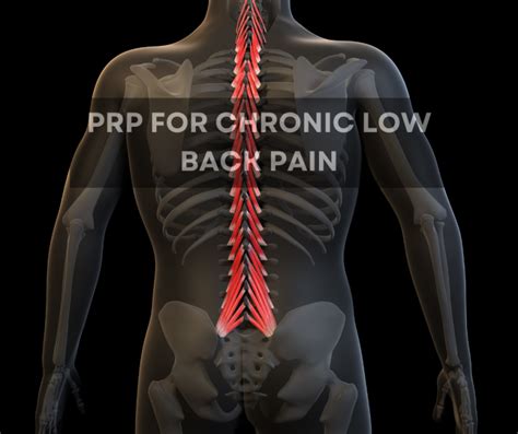 Prp For Chronic Lower Back Pain Treatment Regenexx® Pittsburgh Surgery Alternative