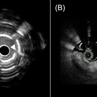 Assessment Of Calcium Fracture By Hd Ivus And Ofdi Gw Guide Wire Ofdi