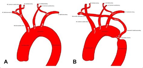 A 3 Dimensional Shaded Surface Display Of Aortic Arch Ascending And