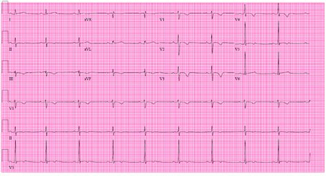 Ecg Of The Month 21 Year Old Male Presents With Exertional Syncope