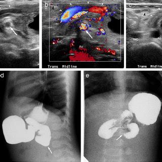 Malrotation without midgut volvulus in a 20-day-old boy. Transverse US ...