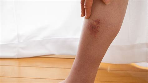 5 Reasons That You Need to Go to the ER for Cellulitis - GoodRx