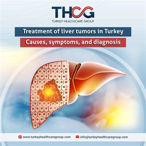 Treatment of liver tumors in Turkey 2024 | Causes, symptoms, and ...