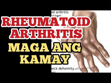 Rheumatoid Arthritis Namamaga Ang Kamay At Paa Payo Ni Doc Willie