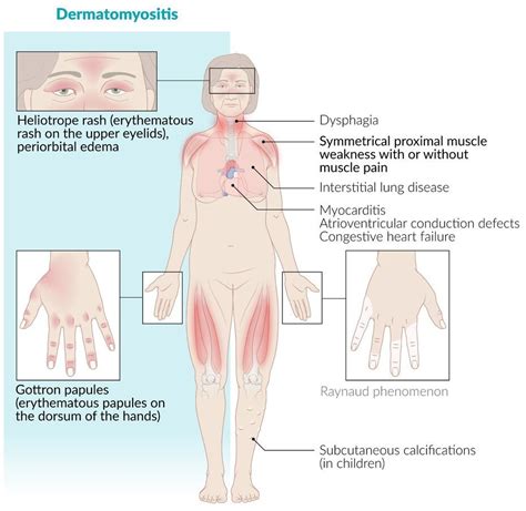 Dermatomyositis Medical Junction