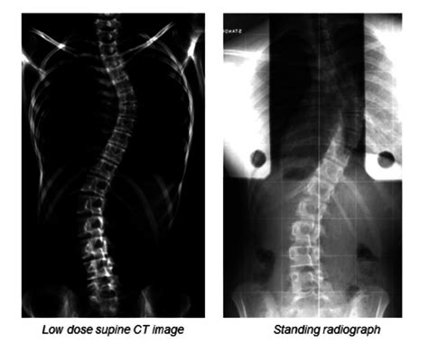 An Example Of A Reformatted Supine Ct Image Cobb 46° Left And The Download Scientific Diagram