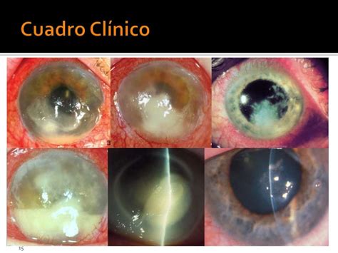 Micosis Oculares