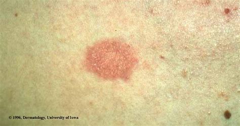 Pityriasis Rosea Picture From Ui Dermatology Hardin Md