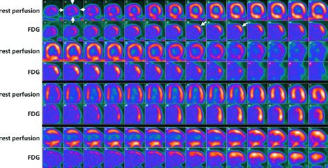 15 PET CT Images Showing A Medium Sized Perfusion Defect In The Apical