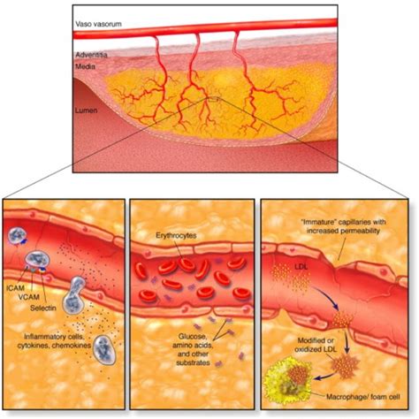 1 A Depiction Of The Progression Of Atherosclerosis Showing The