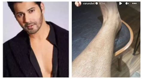 Varun Varun Dhawan Sustains Leg Injury While Shooting His Next Post