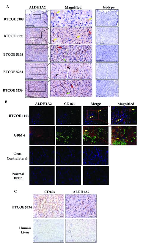 Expression Of Aldh1a2 In The Gbm Tumor Microenvironment A