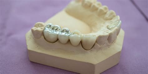 Safe Removal of Amalgam Fillings | Future Dental Cairns