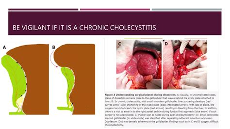 Safe Cholecystectomy Pptx