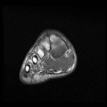 Osteomyelitis And Septic Arthritis Diabetic Foot Radiology Case