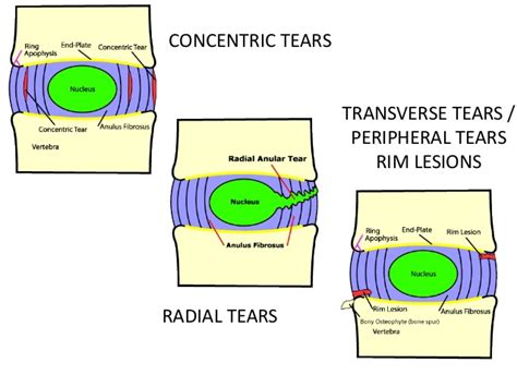 Imaging Back Pain Part 1 Mycme