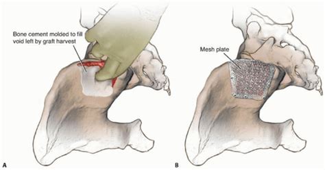 Iliac Crest Bone Graft Harvesting Musculoskeletal Key