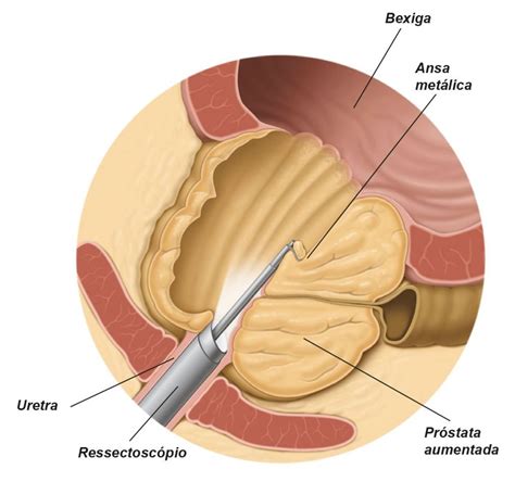 Cirurgia Endosc Pica Para Hiperplasia Prost Tica Benigna Dr Fernando