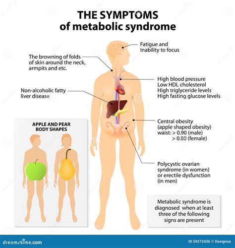 Metabolic Syndrome Infographic In Minimal Outline Style Royalty Free