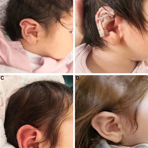 The Neonate S Auricle A Stahl S Ear Before Correction B Molding