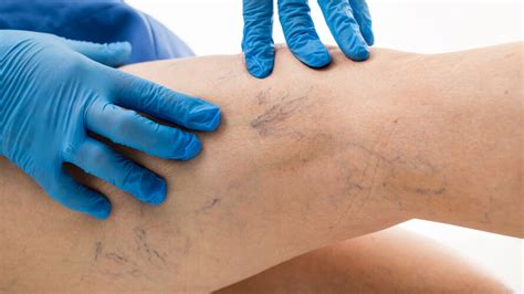 Spider Veins: Causes, Symptoms, and Treatment | In The Know