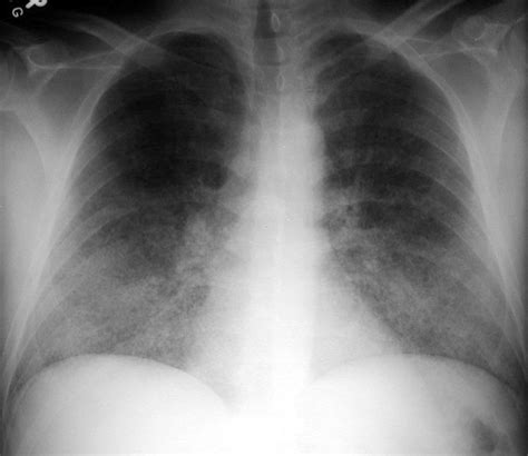 Dark Lung Fields