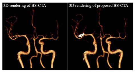 Diagnostics Free Full Text Metallic Component Preserving Algorithm Based On The Cerebral