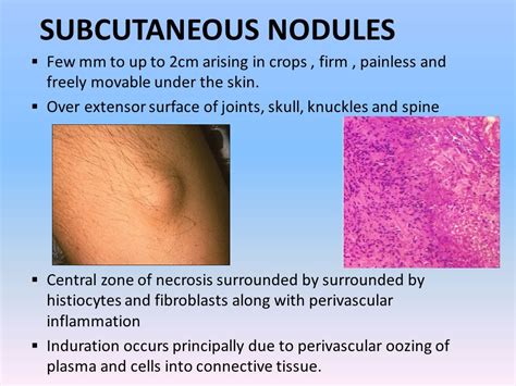 Subcutaneous Nodules Rheumatic Fever