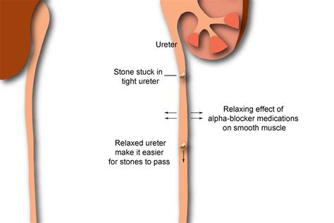 Kidney/Renal Stone Treatment/Removal Surgery in Navi Mumbai