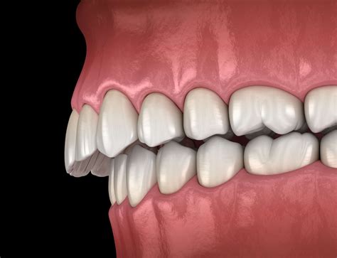 Class 3 Malocclusion How To Correct With Orthodontics